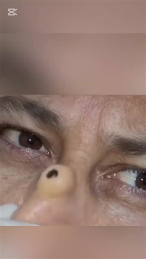 30-Year-Old Blackhead Removal Story