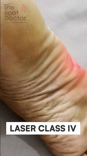 Uses of class IV laser | The Foot Doctor Hospital