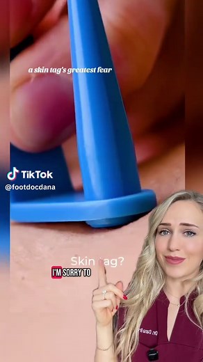Skin Tag Removal: Effective Home Remedies Explained