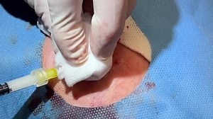 Very large facial abscess. So full and under pressure see the drainage and insta