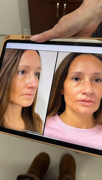 Lip Filler Transformation: Before and After Comparison