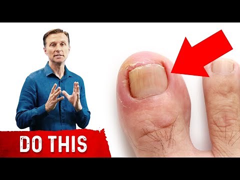The Causes of Ingrown Toenails