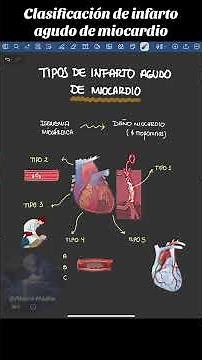 Clasificación de infarto Agudo de Miocardio 🤯 #medicina #infarto