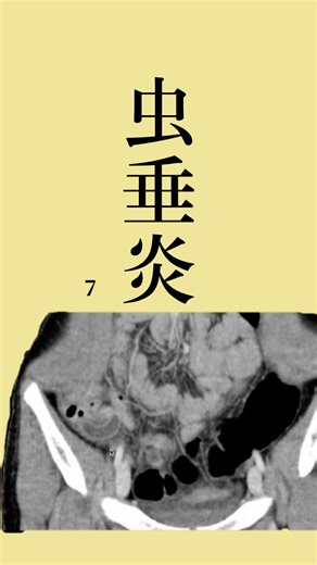 虫垂炎について解説しました。
