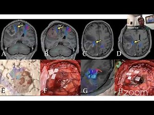 Maximal Safe Resection Of High Grade Glioma