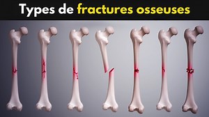 1.3K views · 116 reactions | Comprendre les fractures du fémur : Un...