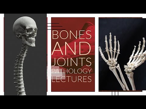 BONES AND JOINTS PATHOLOGY lecture 2 Congenital Disorders of bone made easy with important points