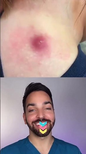 Popping a giant pimple (boil) #shorts #pimplepopper