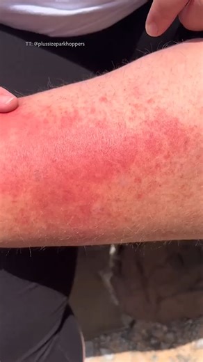 If you’ve ever noticed a skin condition after a hot day walking around a theme park, you may have experienced what’s being called on TikTok the 'Disney rash'. | PinkNews