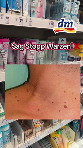 Effective Strategies to Treat Warts