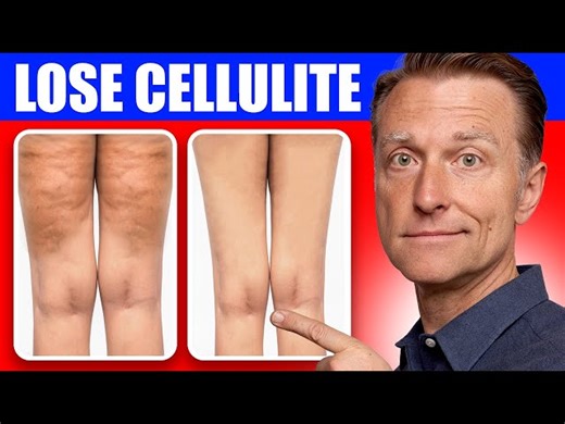 How to Effectively Get Rid of Cellulite by Addressing Its Root Causes and Implementing Targeted Care