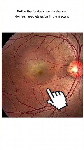 CSCR Explained in 30 Sec – Fundus + OCT Finding 🔍👁️ #Ophthalmology #OCT #CSCR #shorts