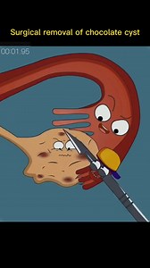 105K views · 529 reactions | #chocolate #cyst #surgical #removal #foryou #fypシ #sciencefacts #mathematics#physics#life #subject #science #quantumphysics, #fyp #foryou #tiktok #lnteresting#science#physics | Sience | Facebook