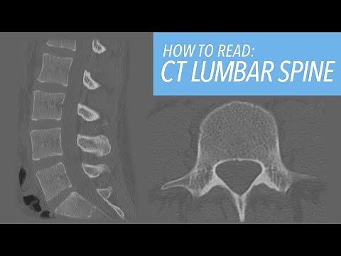 How to Read a CT of the Lumbar Spine: A Beginner's Approach