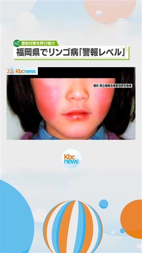 「リンゴ病」警報レベル 福岡県が感染対策呼びかけ◆両ほほに赤い発疹が出る伝染性紅斑病、いわゆる「リンゴ病」が福岡県内で急増し、県は２０１０年以来の「警報レベル」に達したと発表し、感染対策を呼びかけています。#福岡 #福岡のニュース #KBC #九州朝日放送 #tiktokでニュース