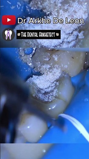 AMAZING Caries Removal #dental #toothfilling #dentistry #dentist