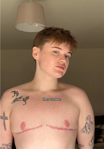 Top Surgery Insights for Transgender and FTM Individuals