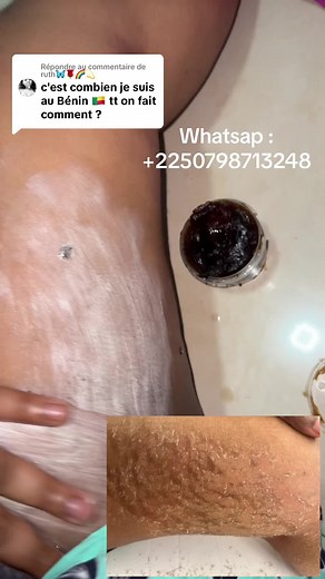 Traitement des vergetures : conseils et témoignages