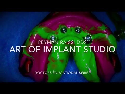 Impression technique for Full arch fixed Implant restoration & some personal pearls