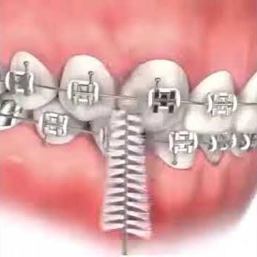 How to use interdental brushes with braces