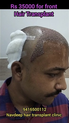 High Density Frontal Hair Transplant Result | Hair Transplant Cost & Details