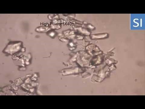 Uric acid crystals urine !!!