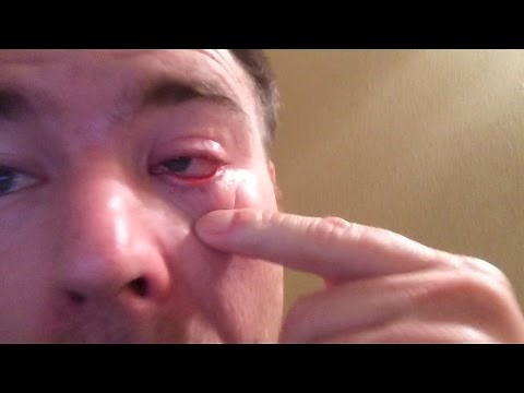 Something is Stuck in my Eye