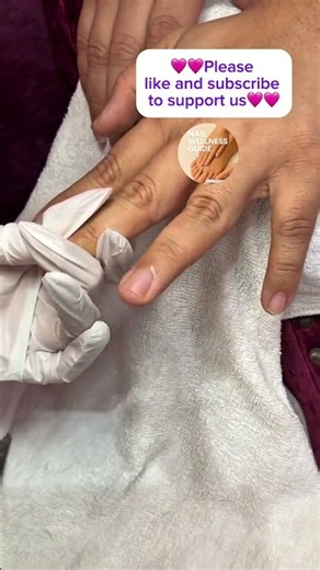 😣 Ingrown Toenail Pain? Watch This Satisfying Relief! 🦶✨ #nails