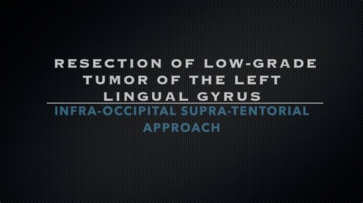 Infra-Occipital Supra-Tentorial Approach for Resection...
