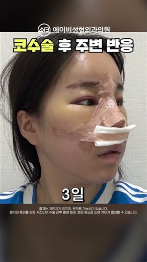 코 재수술, 얼마나 높여야 예쁠까?👆 #shorts
