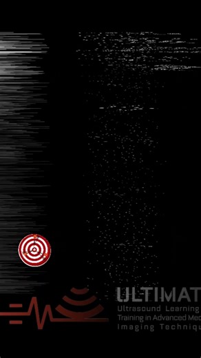 ''Target Sign'' Intussusception on Bedside Ultrasound ULTİMATE #shorts #ultrasound #emergencymedicin