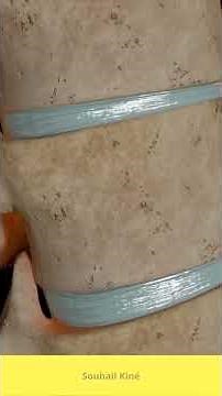 Burst fracture vertebra