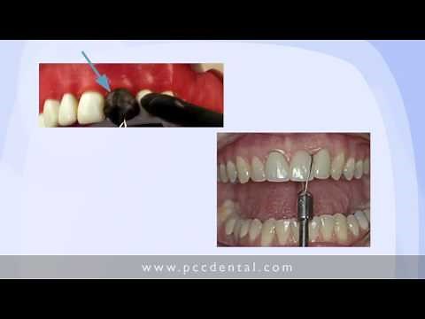 Ask Gordon: Removing a Fixed Partial Denture