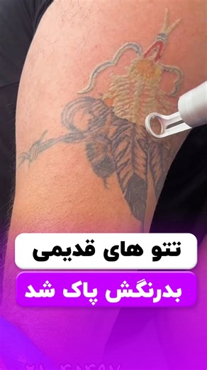 ‎لیزر موهای کرکی| ریمو تتو| جای جوش‎ on Instagram‎: "😍 پاک کردن تتو ، تاتو 👇🏻 با لیزر کیو سوییچ برای همیشه میتونی با جای خالکوبی ، تتو ، تاتو خداحافظی کنی 😍👇🏻 ________ ❌ برای اطلاع از قیمـ.ت و مشاوره کلمه « #تتو » کامــ.نـت کن _________ ◾️ اگه دوست داری پوست زیبا تر و‌جوان تر داشته باشی میتونی از خدمات زیبایی اندولیفت ، لیزر جوانساز ، تزریقات جوان کلینیک زیبایی ارکیده هم استفاده کنی 👇🏻 پیج ما رو دنبال کن 👇🏻 ‏😍 @laser_orkideh ‏😍 @laser_orkideh ‏😍 @laser_orkideh ——————- #ریمو #تتو #ری