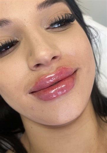 Perfect Lip Tutorial with Hyaluronic Acid