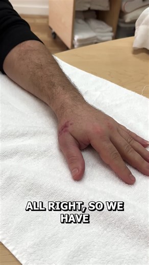 Look at the difference between these two thumbs. This patient is recovering from an extensor tendon laceration and an abductor pollicis longus laceration. On one side, you can see how much extension we're working toward. On the other, where we are now. But here's something important: when we talk about opposition, we're not just looking for any contact between thumb and fingers. True opposition is nail to nail—tip of thumb to tip of index finger. If the fingers are flat, that's not opposition. S