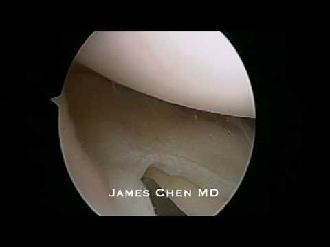 Arthroscopic Saucerization of Discoid Meniscus