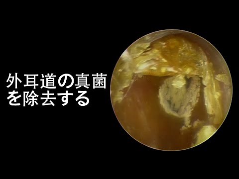 Remove Fungus From Gentleman's Ear Canal