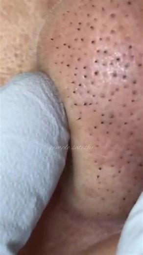 Amazing ❤️ #fyp #explore #foryou #pimplepopperaddict #satisfying #pimplepop #pourtoi #tiktoklongs #pimple