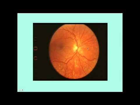 Hypertensive Retinopathy - CRASH! Medical Review Series