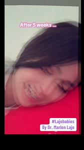 581 reactions · 27 shares | 1st day , 2nd week , 5th week #rhinoplastyjourney #lajobabies #docmarlonlajo #marlonlajo #LaJo #rhinoplasty # | Marlon O. Lajo | Facebook