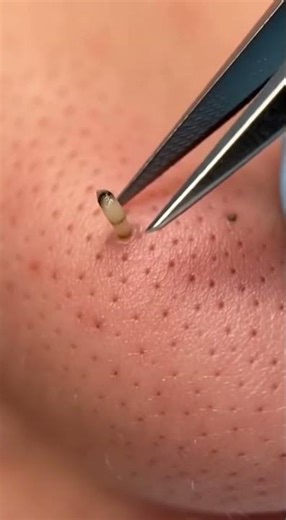 Massive Blackhead Extractions 😱 Deep Facial Treatment