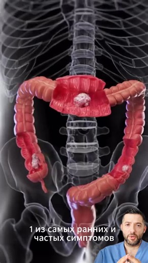 Гарри Акопян on Instagram: "Кровь при дефекации — не всегда геморрой. Если кровотечение меняет характер, появляется регулярно или кровь смешана со стулом, это тревожный сигнал. Рак толстой кишки может долго маскироваться под «безобидные» симптомы. При изменениях — не ждать и не лечить на глаз, а пройти обследование. Это может спасти жизнь. #геморрой #кровьвстуле #рактолстойкишки #онконастороженность #доказательнаямедицина"