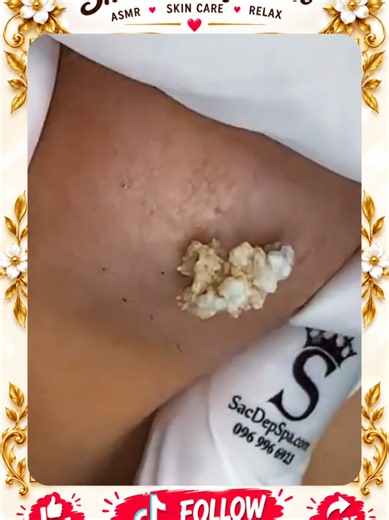 Deep Blackhead Extraction & Satisfying Popping | Wait for the most satisfying pop 😳🫣 You won’t believe what comes out! #pimplepoppersatisfying #Acne #pimple #Blackhead #Satisfying