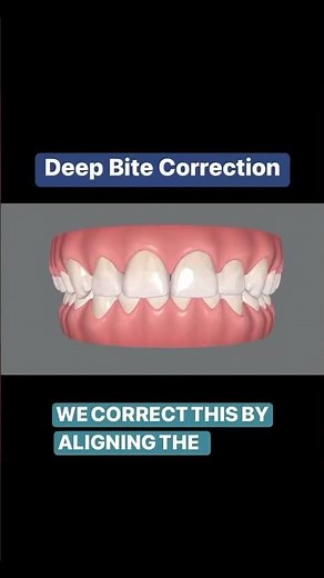 Teeth alignment to correct a deep bite.