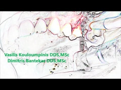 Crestal approach of sinus lift with Densah burs.Step by step by Dr V.Kouloumpinis.