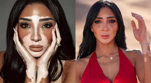 Conoce a Logina Salah, Miss Egipto y la primera concursante con vitíligo en Miss Universo