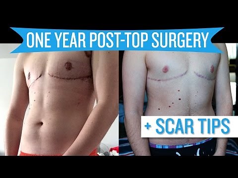 One Year Post Top Surgery + Scar Tips