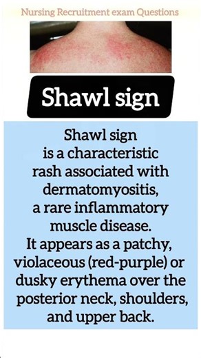 shawl sign is a characteristic rash associated with dermatomyositis @anandsnursingfiles