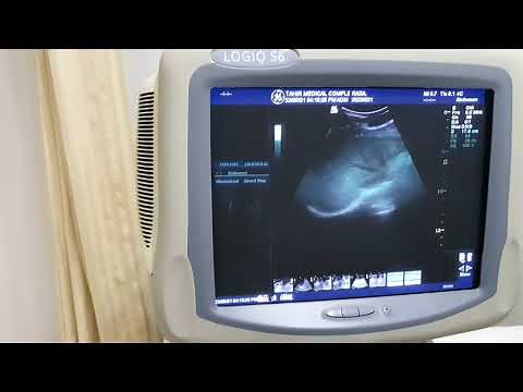 TGC | Time Gain Compensation | Knobology of Ultrasound Machine | How to set TGC